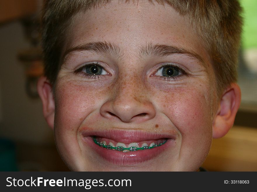 Boy smiling in braces