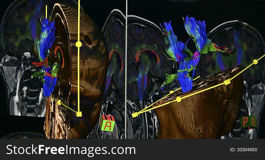 Diffusion tensor imaging is technique of Brain Magnetic Resonance image - allows the mapping of the diffusion process of molecules, mainly water in tissues, especially in brain. Color coded white matter tract of the brain can be seen in 3 different directions: up-down, left-right, forward-backward. Diffusion tensor imaging is technique of Brain Magnetic Resonance image - allows the mapping of the diffusion process of molecules, mainly water in tissues, especially in brain. Color coded white matter tract of the brain can be seen in 3 different directions: up-down, left-right, forward-backward