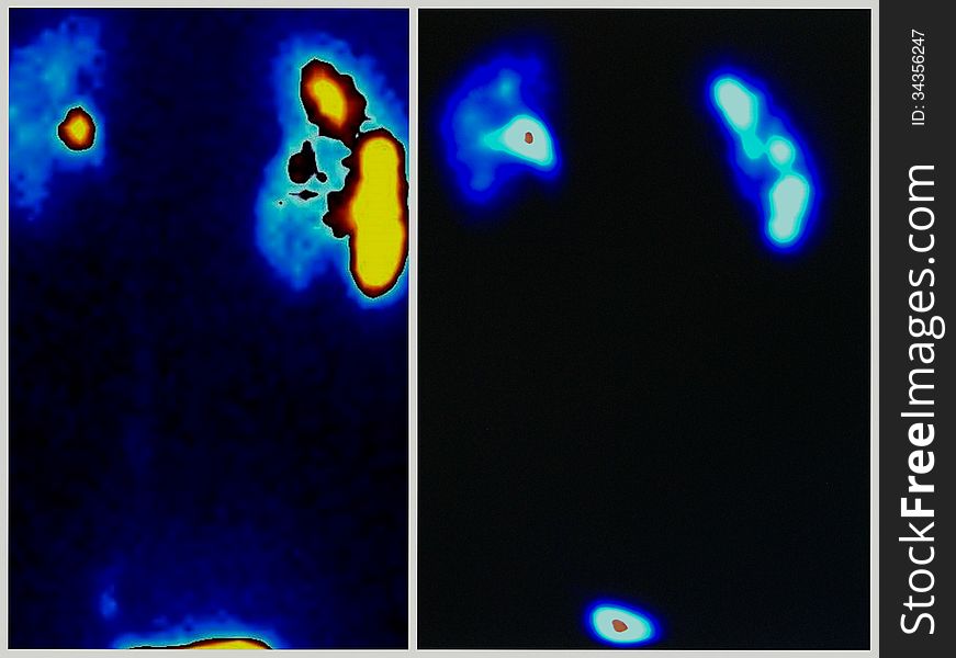 On the left site of image renal upj obstruction due to additional vessel ,on the right site after 4 weeks after laparoscopic pyeloplasty ,real result of treatment this pathology. On the left site of image renal upj obstruction due to additional vessel ,on the right site after 4 weeks after laparoscopic pyeloplasty ,real result of treatment this pathology...