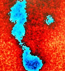 Intramural Obstruction Nuclear Scan Royalty Free Stock Image Intramural Obstruction Nuclear Scan Royalty Free Stock Image