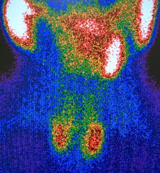 Parathyroid Pathology , Nuclear Scan Royalty Free Stock Image Parathyroid Pathology , Nuclear Scan Royalty Free Stock Image