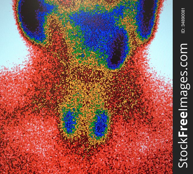 There are salivary glands upper 1/3 of image the black color with violet borders parotid submandibular and sublingual ,its examination of parathyroid ,but simultaneously radiologist can see salivary glands. There are salivary glands upper 1/3 of image the black color with violet borders parotid submandibular and sublingual ,its examination of parathyroid ,but simultaneously radiologist can see salivary glands