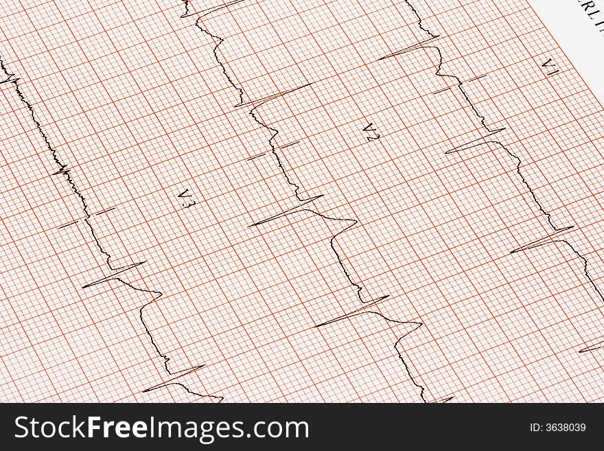 A closeup of a graph showing an EKG printout. A closeup of a graph showing an EKG printout.