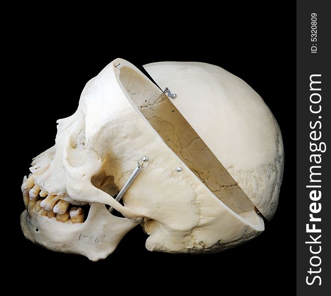 A real human skull with the cap cut away to show the interior of the brain case. Side view with cap. A real human skull with the cap cut away to show the interior of the brain case. Side view with cap.