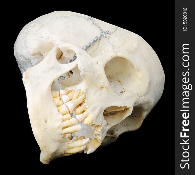 Real human skull with hinged jaw and some missing teeth. Sideways view with skullcap removed. Real human skull with hinged jaw and some missing teeth. Sideways view with skullcap removed.