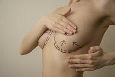 Breasts With Surgery Lines 3 Royalty Free Stock Photography Breasts With Surgery Lines 3 Royalty Free Stock Photography