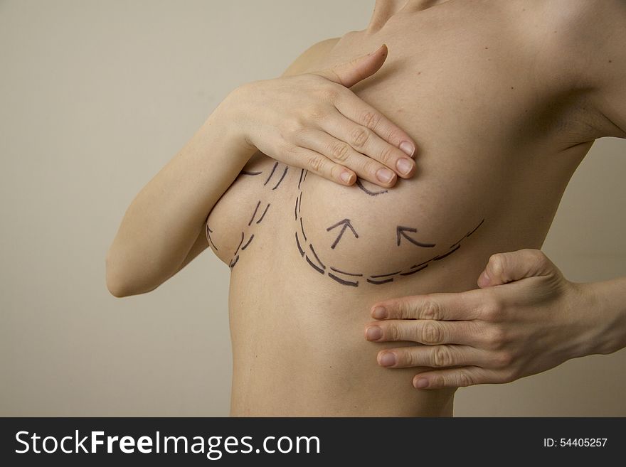 Woman body ready for liposuction operation: with surgery marked lines. Woman body ready for liposuction operation: with surgery marked lines