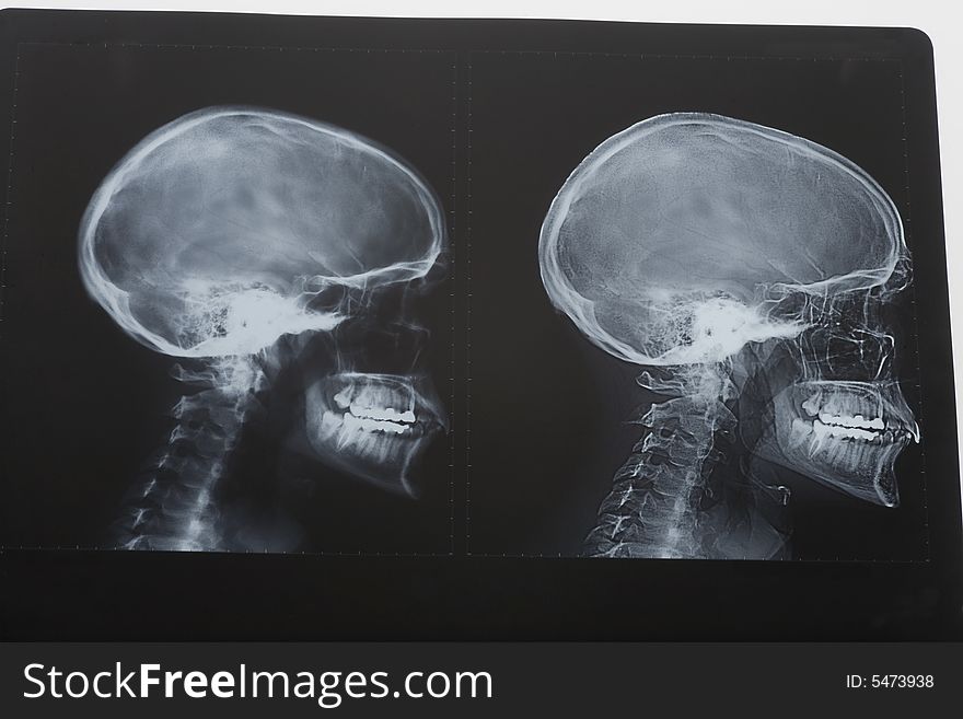 X-rays of human head. X-rays of human head