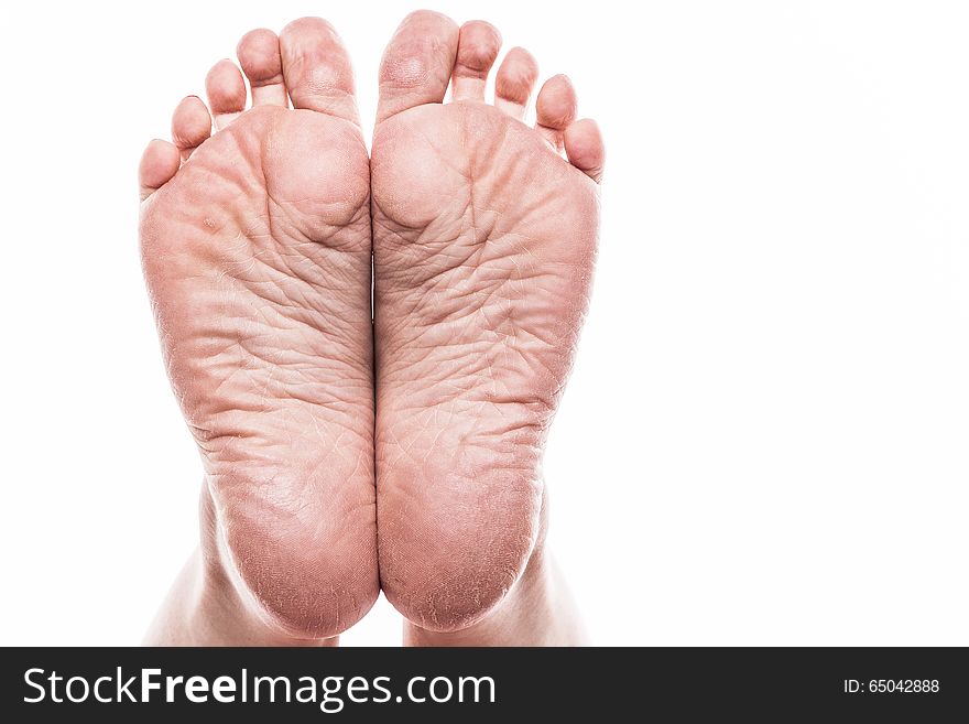 Female Foot With Pedicure And Poor Over-dry Skin On The Heels Of