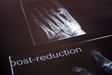 Xray Of Foot Stock Photo