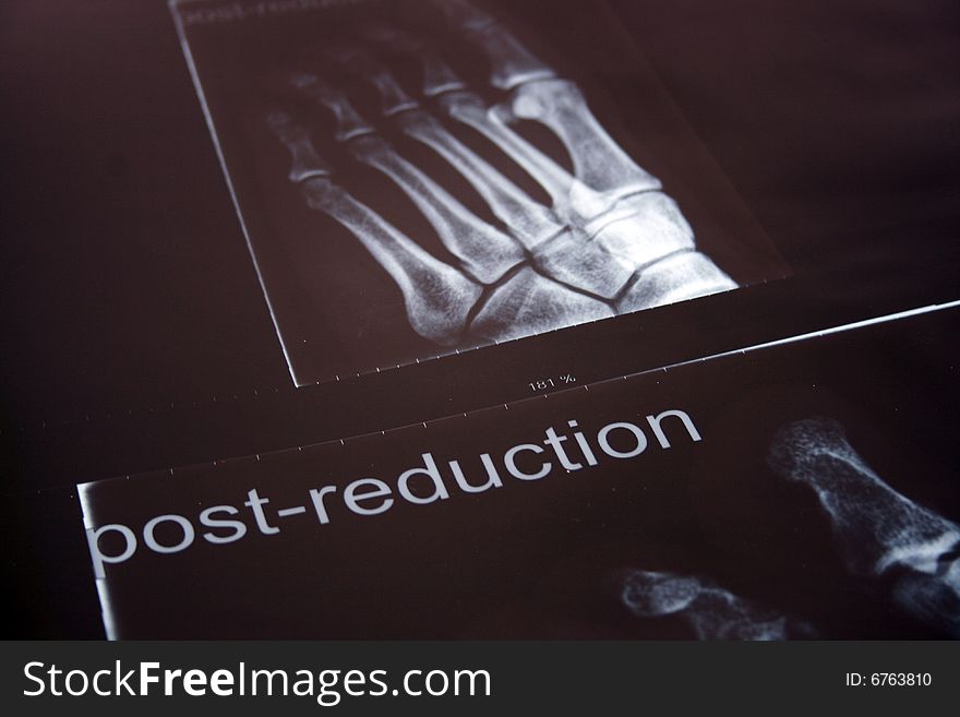 Xray Of Foot