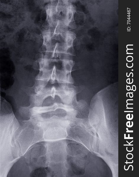 X-ray Picture
