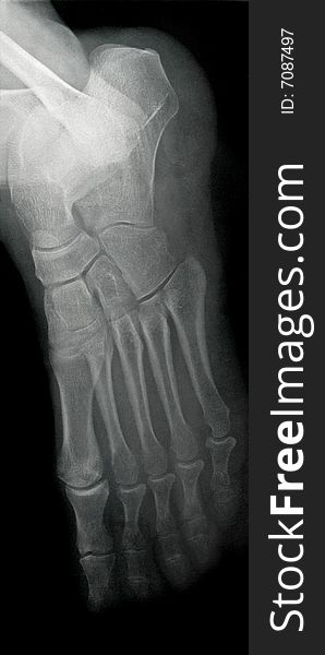 Lateral Foot X-ray