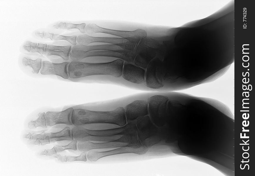 X ray radiography of feet