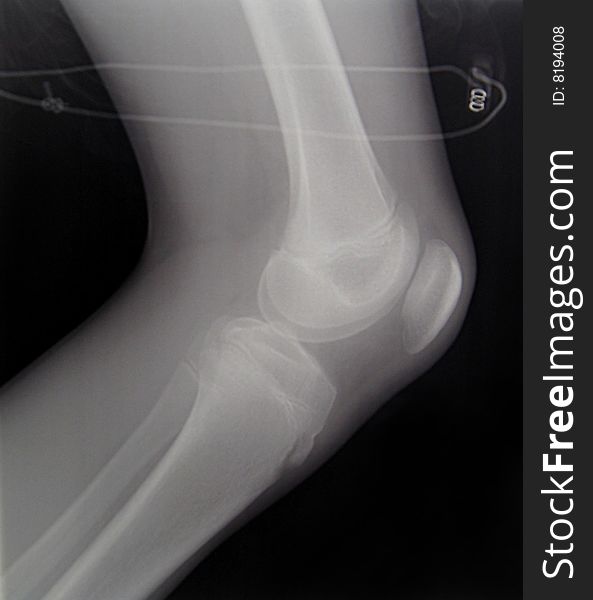 X-ray Diagnostics/knee