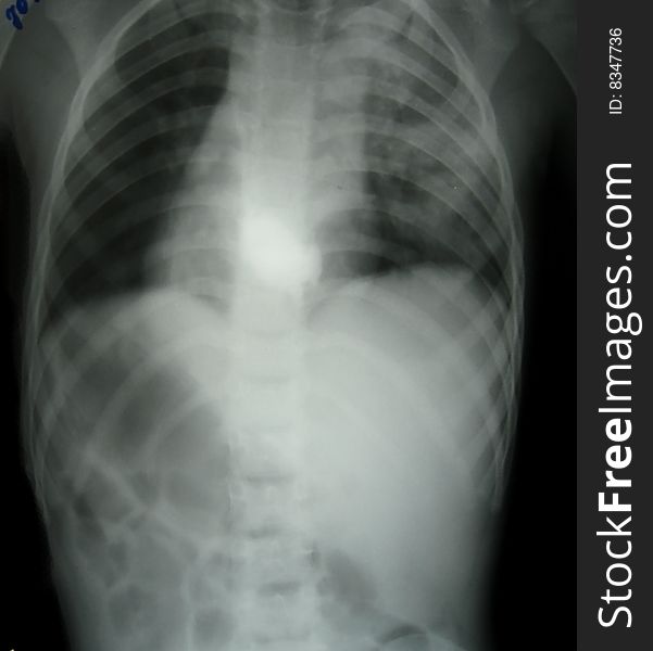 X-ray diagnostics of intestinal obstruction