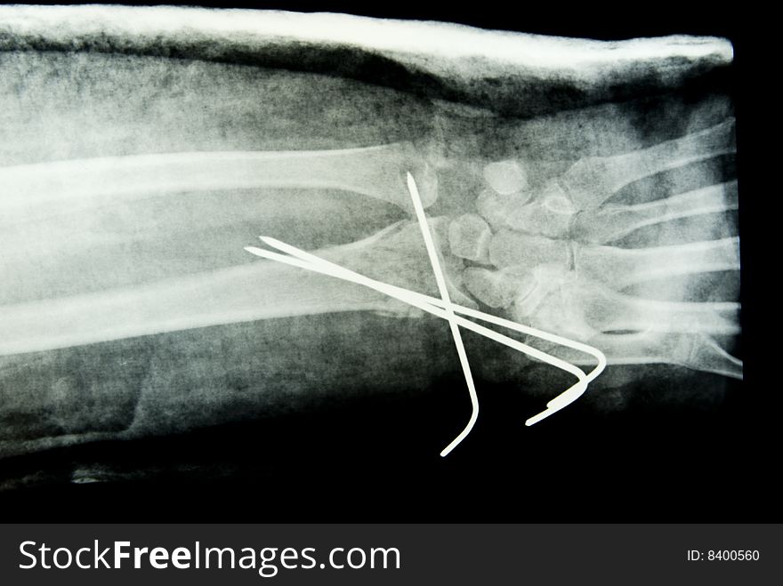 X-ray Of The Hand