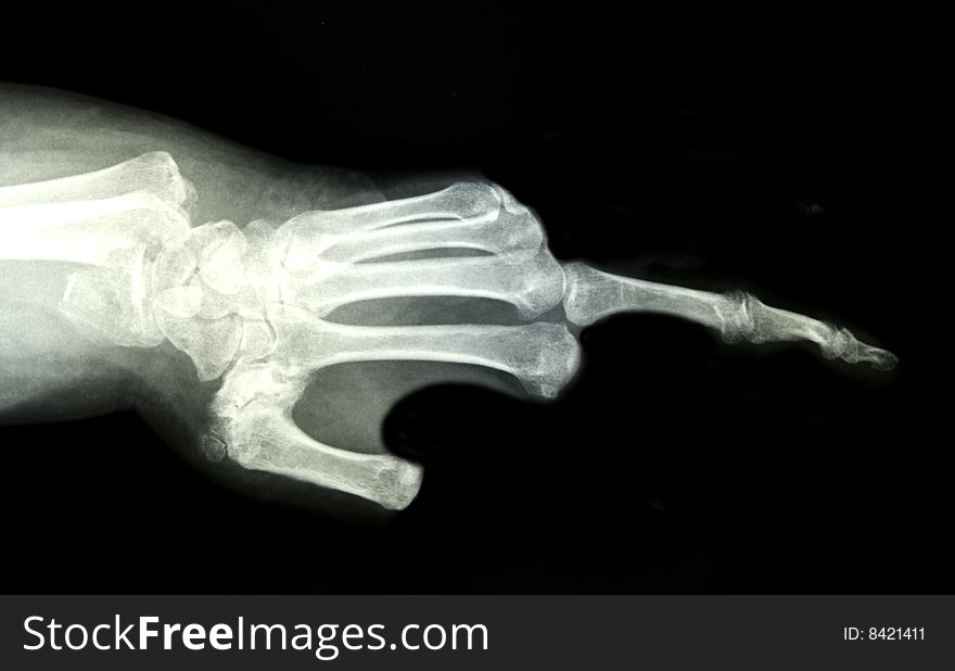 X-ray Of The Hand