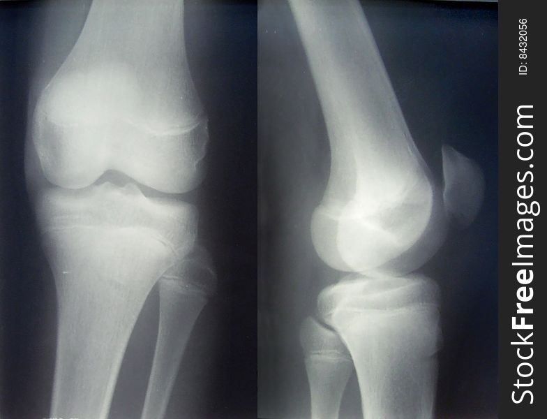 X-ray Diagnostics/knee