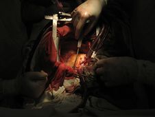 Coronary Artery Bypass Surgery Stock Photography Coronary Artery Bypass Surgery Stock Photography