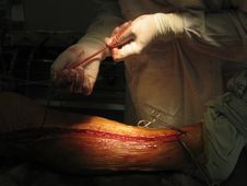 Coronary Artery Bypass Surgery Stock Photography Coronary Artery Bypass Surgery Stock Photography