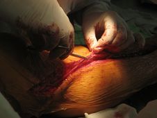 Coronary Artery Bypass Surgery Royalty Free Stock Photography Coronary Artery Bypass Surgery Royalty Free Stock Photography