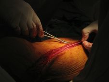 Coronary Artery Bypass Surgery Stock Photo Coronary Artery Bypass Surgery Stock Photo