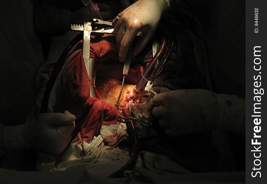 Coronary artery bypass surgery