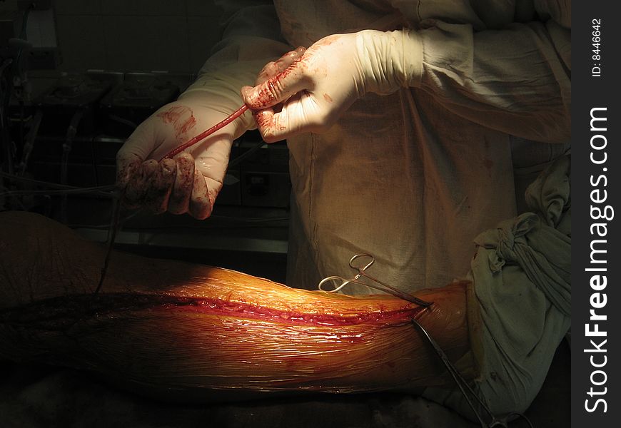 Coronary artery bypass surgery