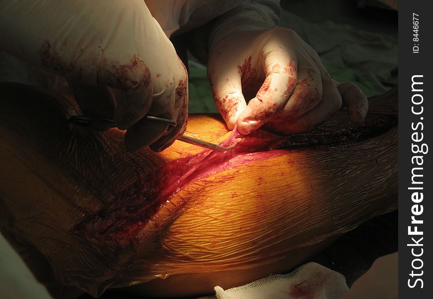 Coronary artery bypass surgery