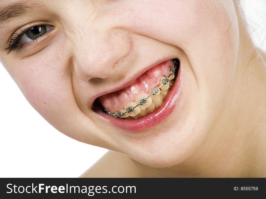 Face of teen girl with brackets on her teeth. Face of teen girl with brackets on her teeth