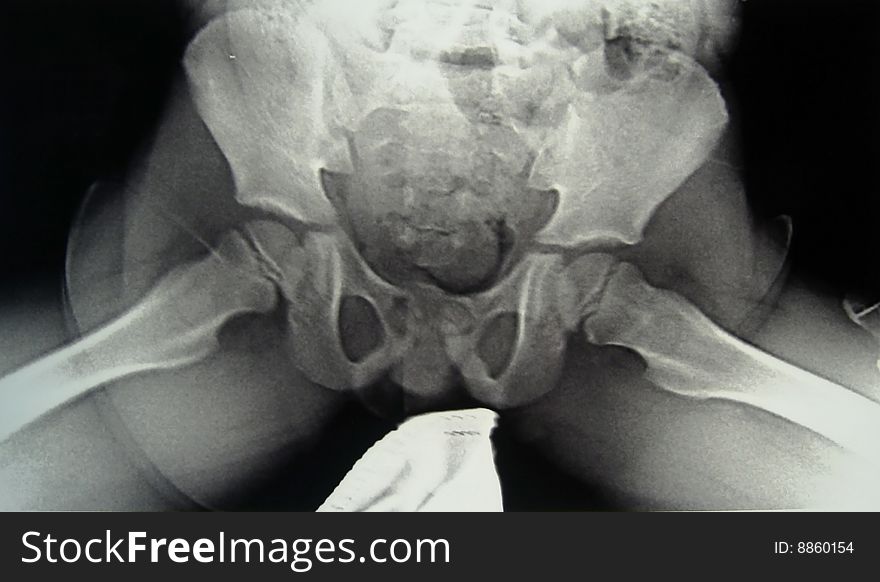 X-ray diagnostics of pelvic bones and hip joint. X-ray diagnostics of pelvic bones and hip joint