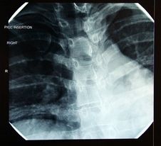 X-ray Of Correct Final PICC Line In Heart Royalty Free Stock Photo X-ray Of Correct Final PICC Line In Heart Royalty Free Stock Photo