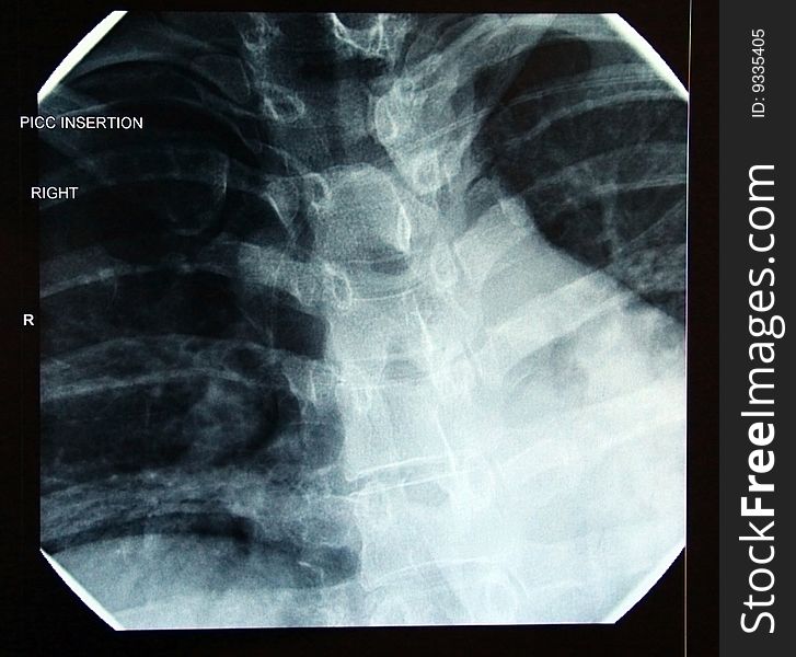 X-ray of correct final PICC (peripherally inserted central catheter) line placement in heart (Female32). X-ray of correct final PICC (peripherally inserted central catheter) line placement in heart (Female32)