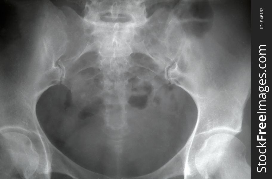 X-ray of the pelvis, medical concept