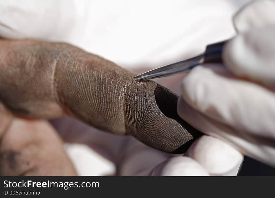 Image of a worker having an object removed from their finger. Image of a worker having an object removed from their finger.