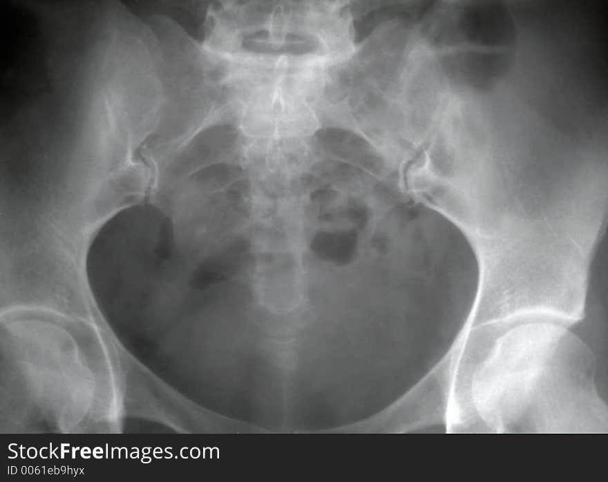 X-ray of the pelvis, medical concept