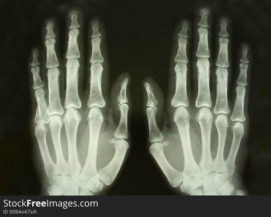 X-ray picture of the palms