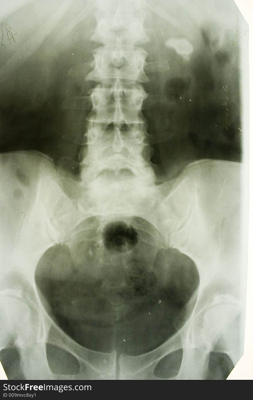 X-ray picture