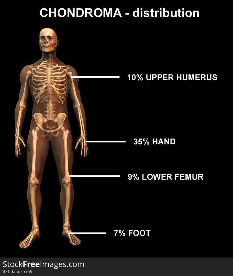 Illustration to show distribution of chondroma in the human body