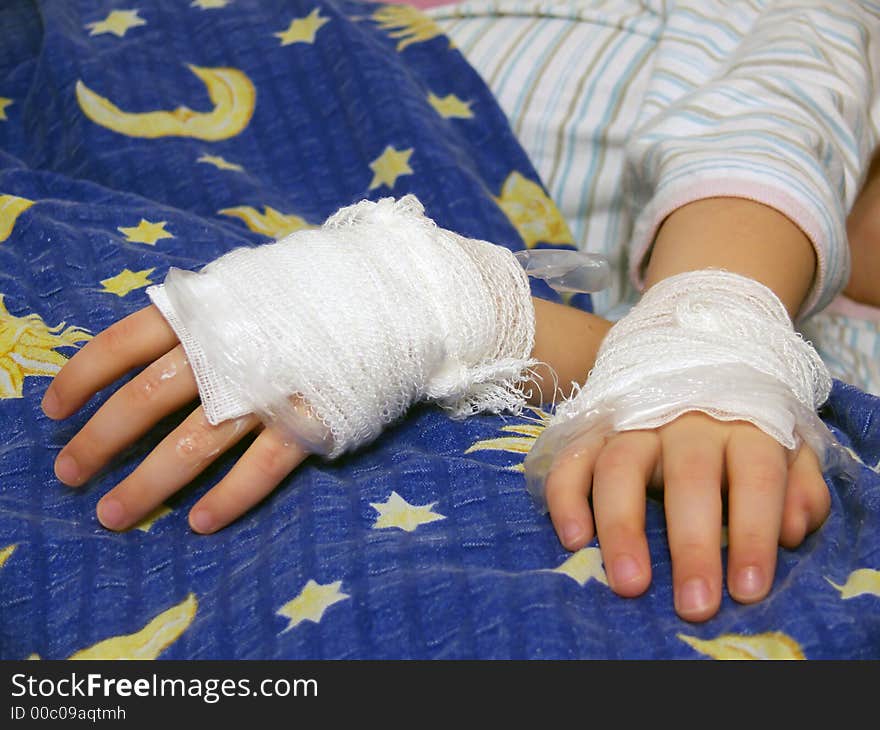 Young girl illness, 
bandage, foil, ointment on the hands, 
burns and scalds hands or allergic hands,