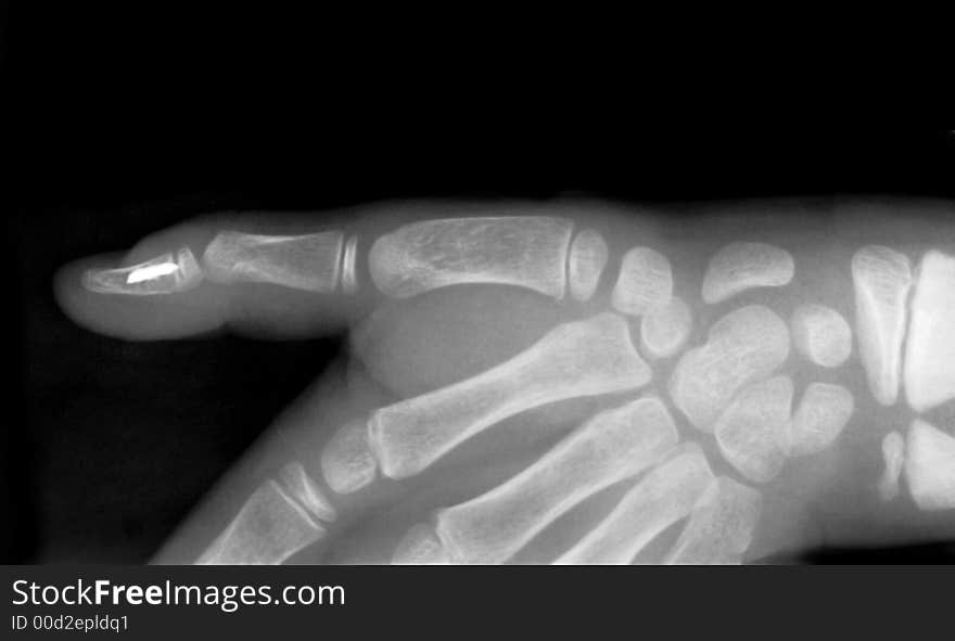 Strange body in human finger on x-ray film. Strange body in human finger on x-ray film