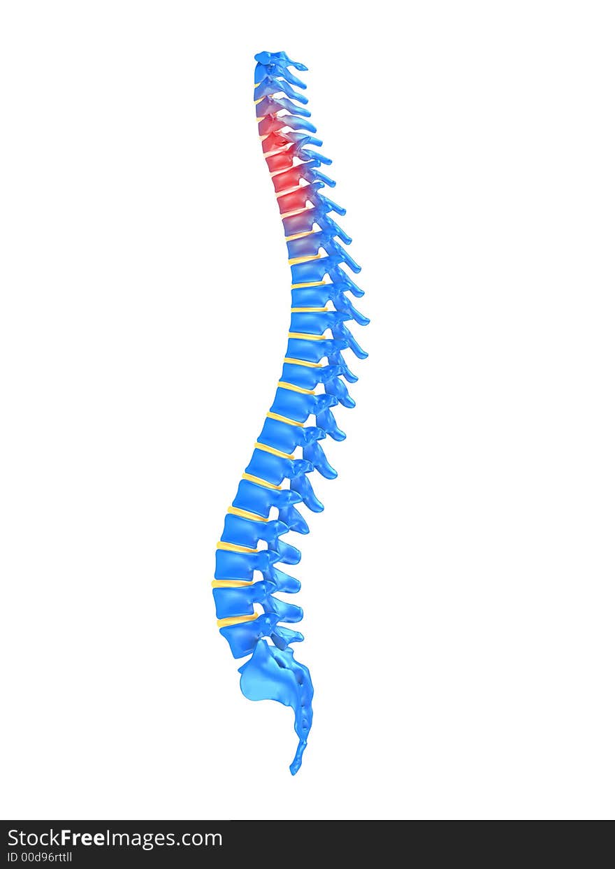 3d rendered anatomy illustration of a slipped disc