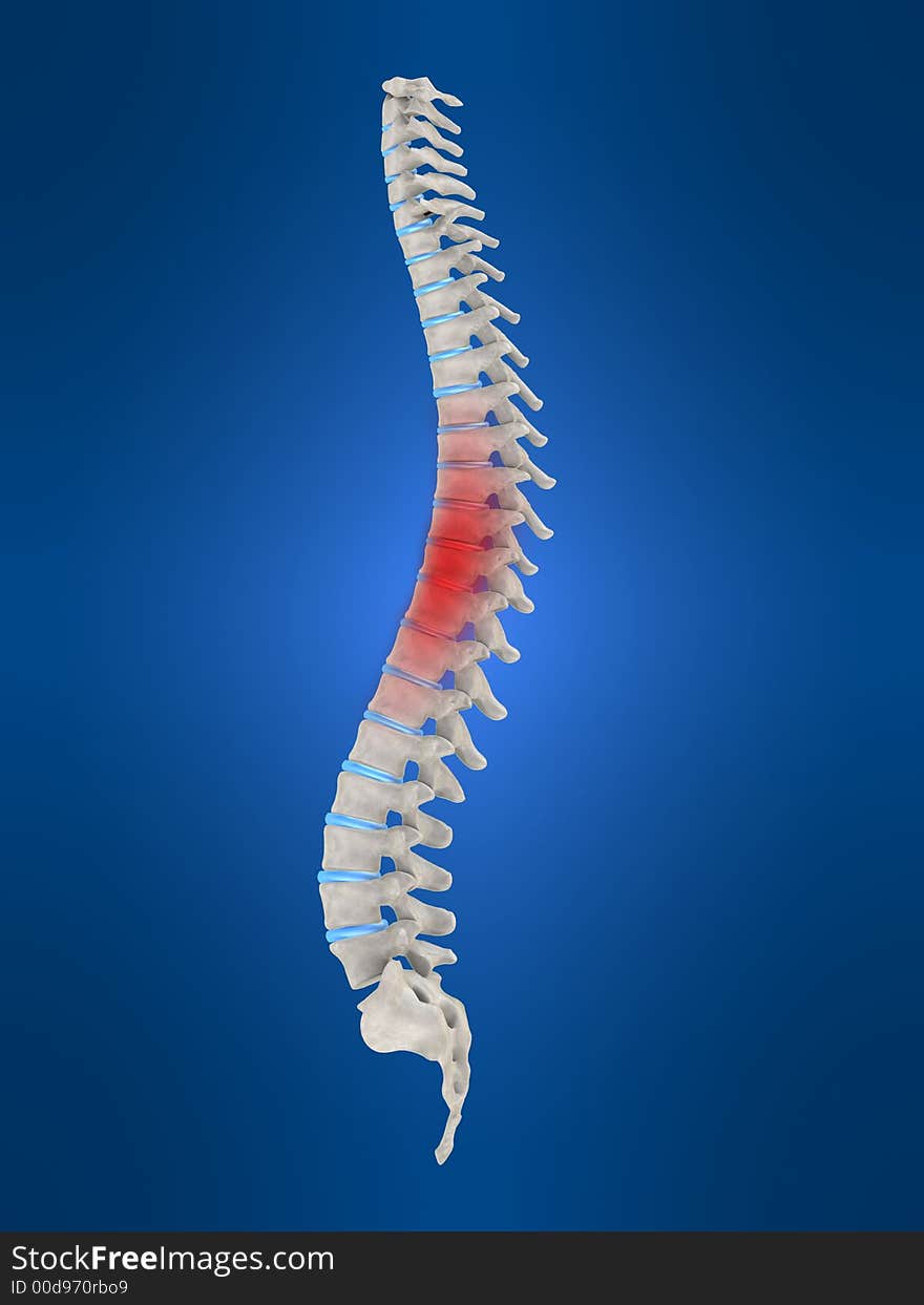 3d rendered anatomy illustration of a slipped disc