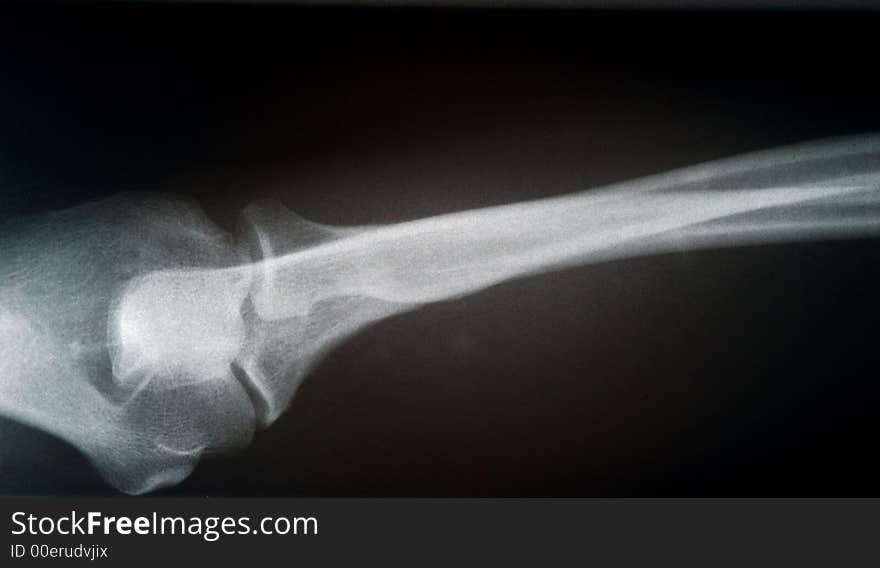 Human X-ray picture of the arm