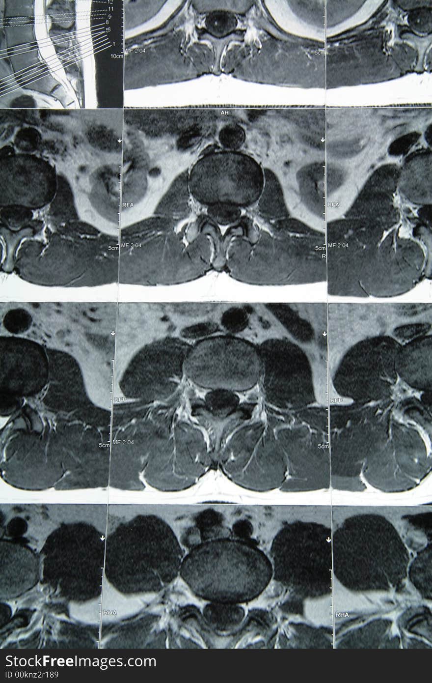 Cross section of magnetic resonance imaging on spine. Cross section of magnetic resonance imaging on spine