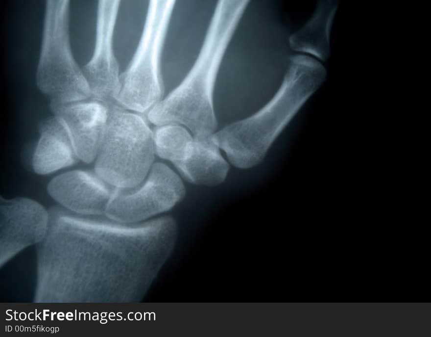 X-ray picture of the wrist