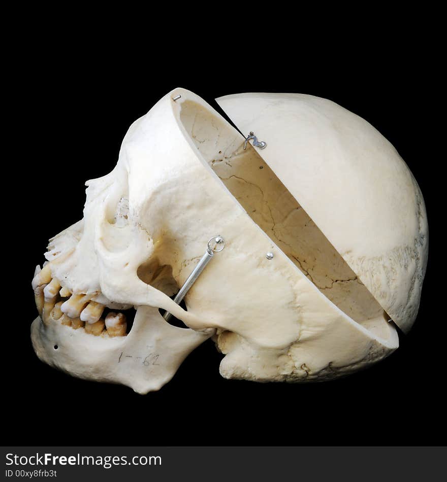 A real human skull with the cap cut away to show the interior of the brain case. Side view with cap. A real human skull with the cap cut away to show the interior of the brain case. Side view with cap.