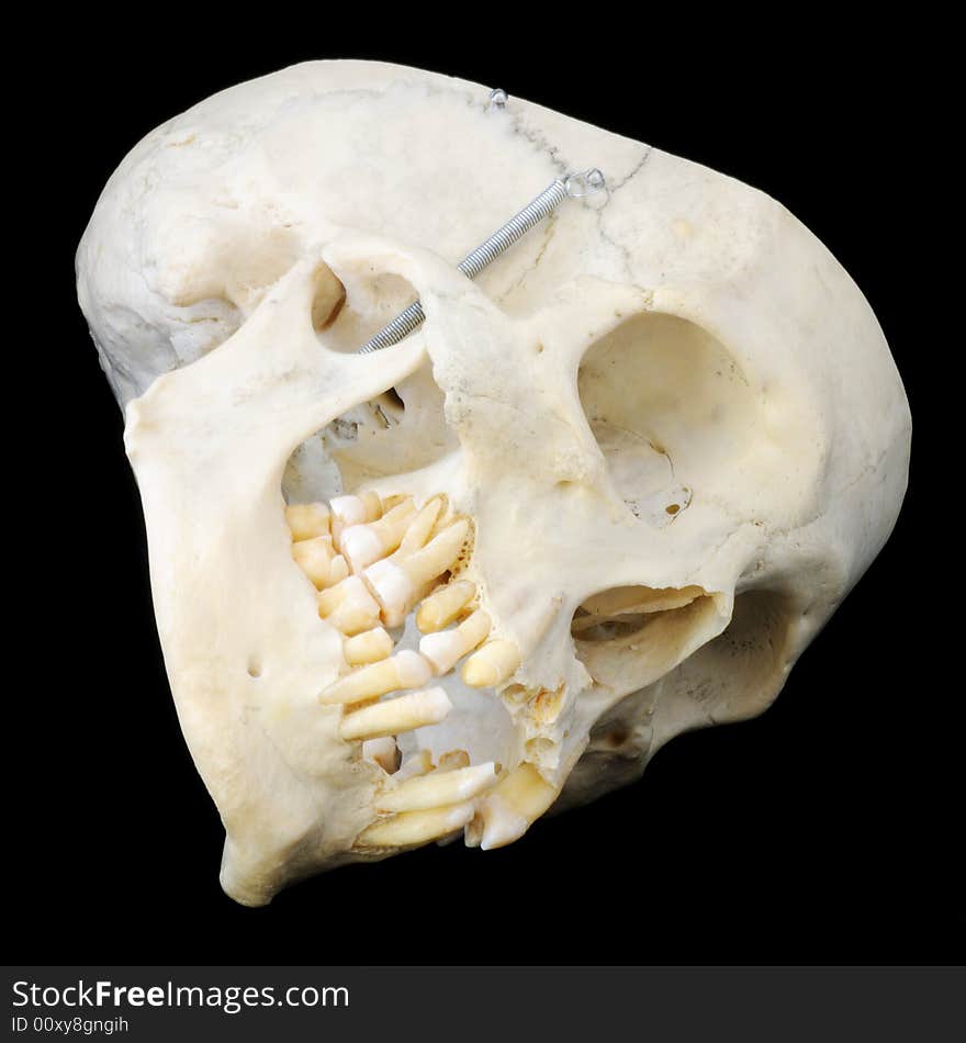 Real human skull with hinged jaw and some missing teeth. Sideways view with skullcap removed. Real human skull with hinged jaw and some missing teeth. Sideways view with skullcap removed.