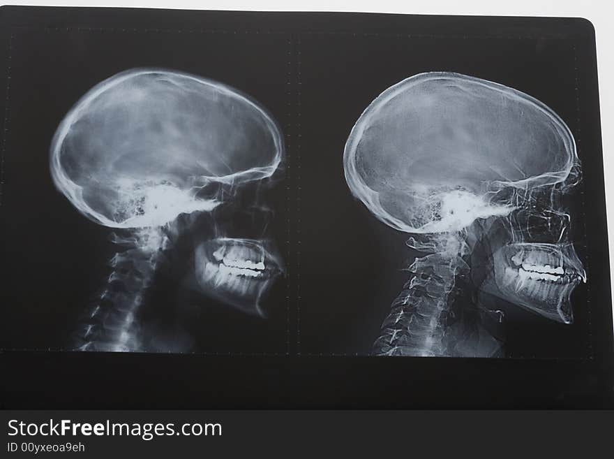 X-rays of human head. X-rays of human head